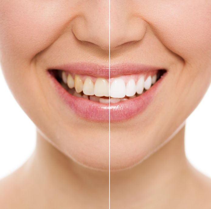 hydrogen peroxide baking soda teeth whitening before after